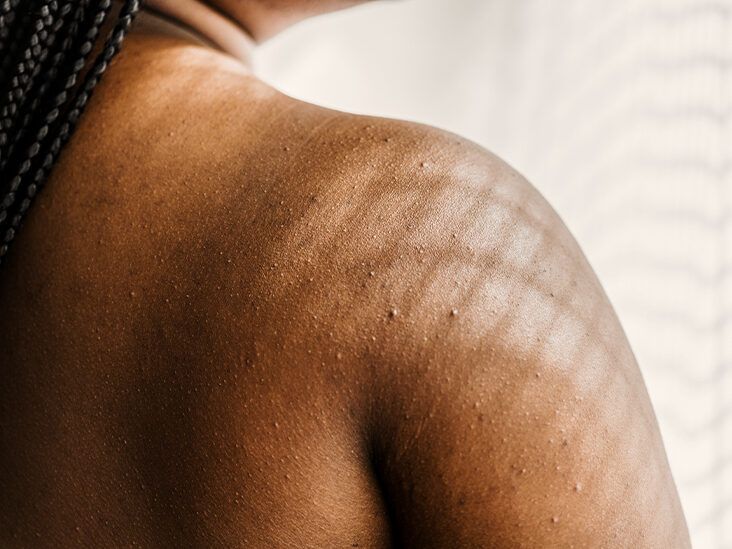 Dark spots on child's back, black sites 