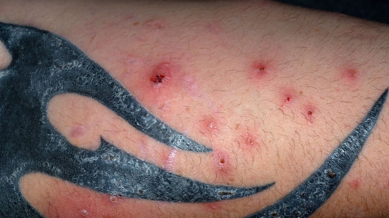 Doctor explains Staphylococcus aureus fatalities and link to eczema
