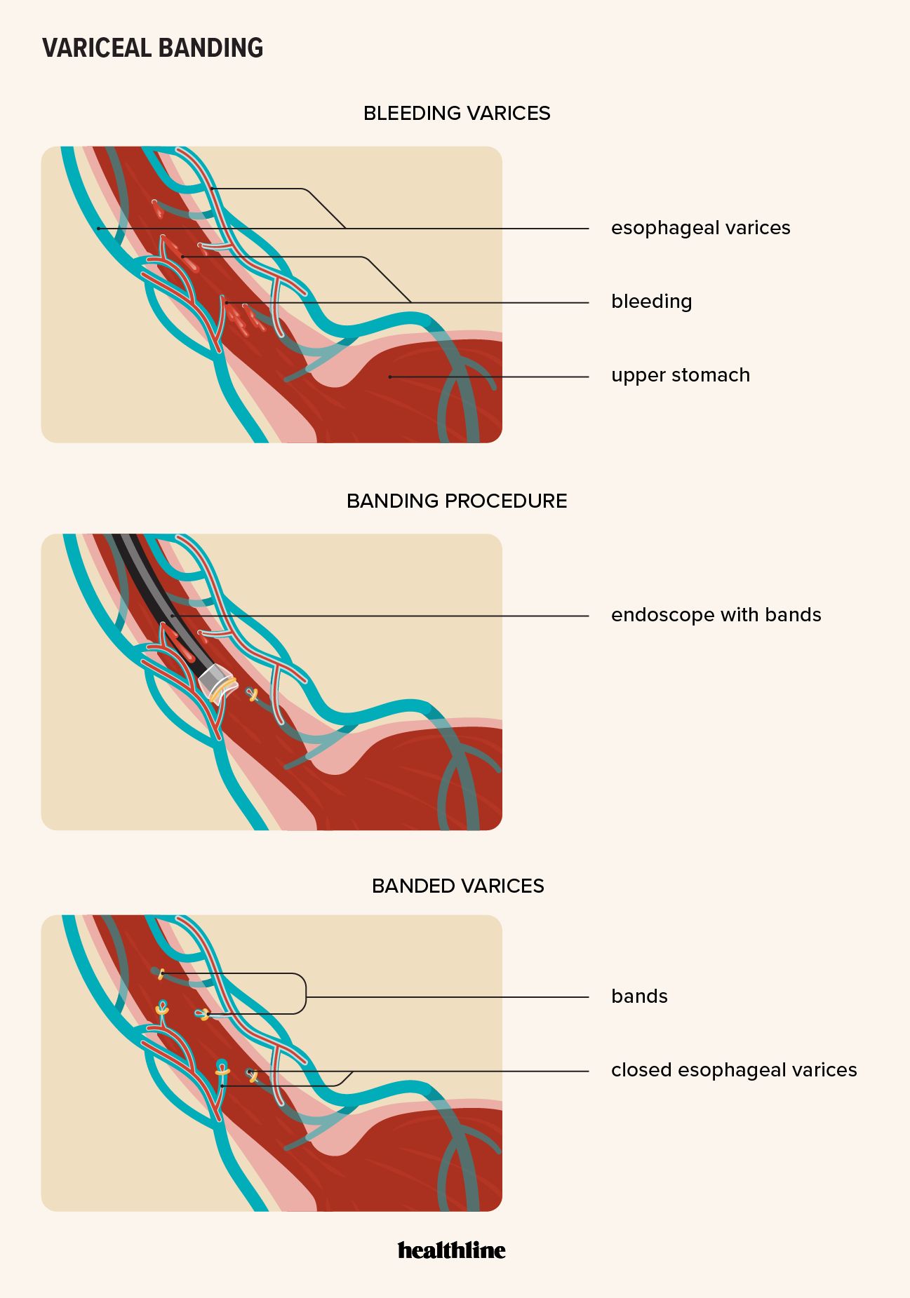 effect of variceal banding procedure on bleeding esophageal varices