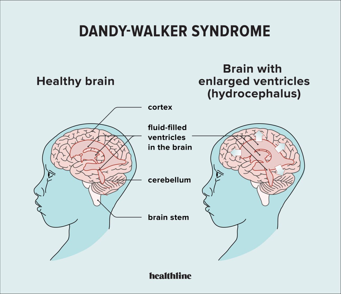 Illustration showing healthy brain vs. brain with enlarged ventricles (Dandy-Walker syndrome)