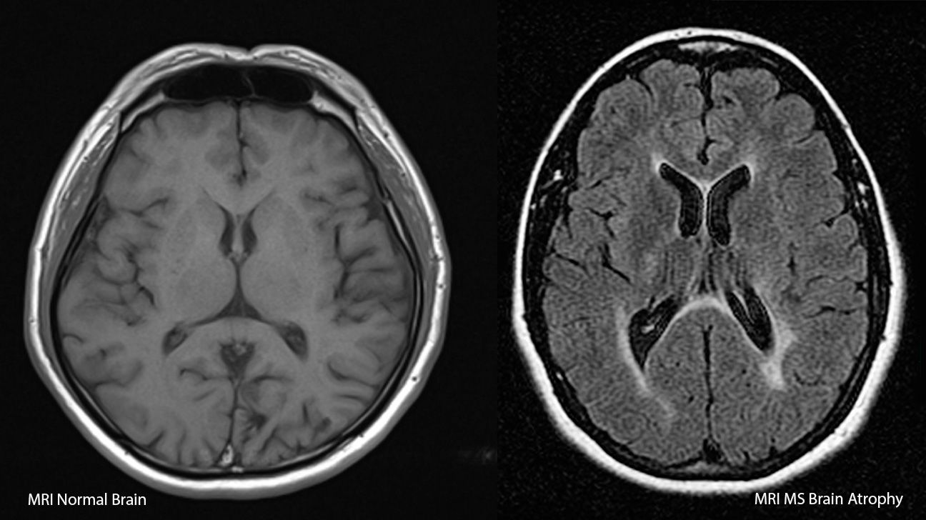 Scan of healthy brain vs MS brain.
