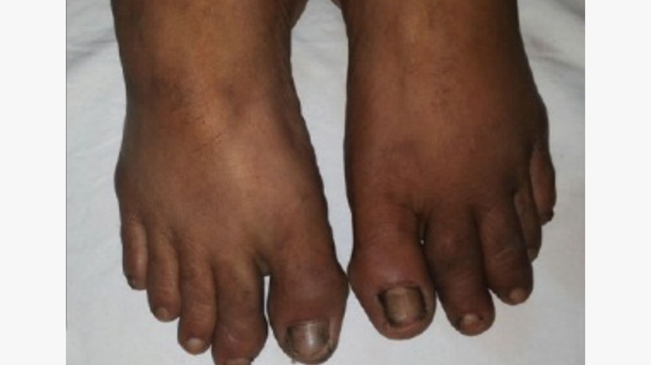 آرتریت پسوریاتیک پا با رنگ پوست تیره