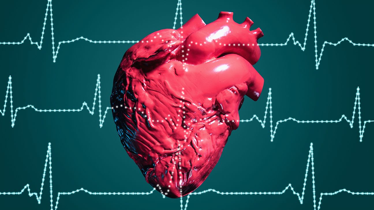 illustration av ett anatomiskt korrekt hjärta tillsammans med EEG av AFib