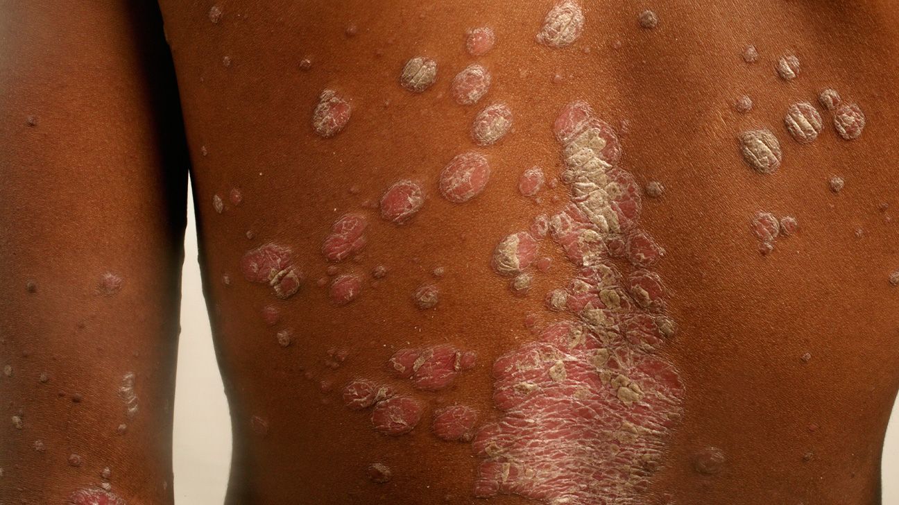 پسوریازیس پلاکی روی پوست سیاه