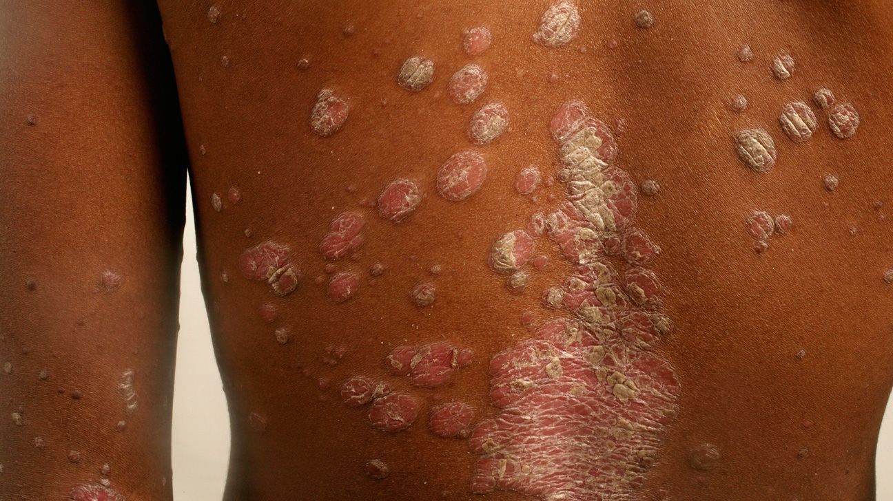 8 Types of Psoriasis: Photos, Symptoms, and More