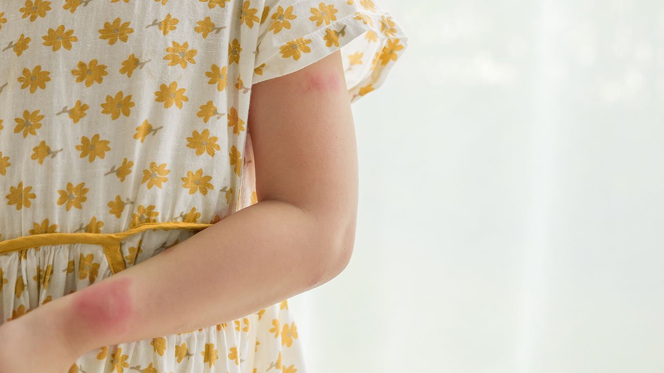 Child with rash on arm