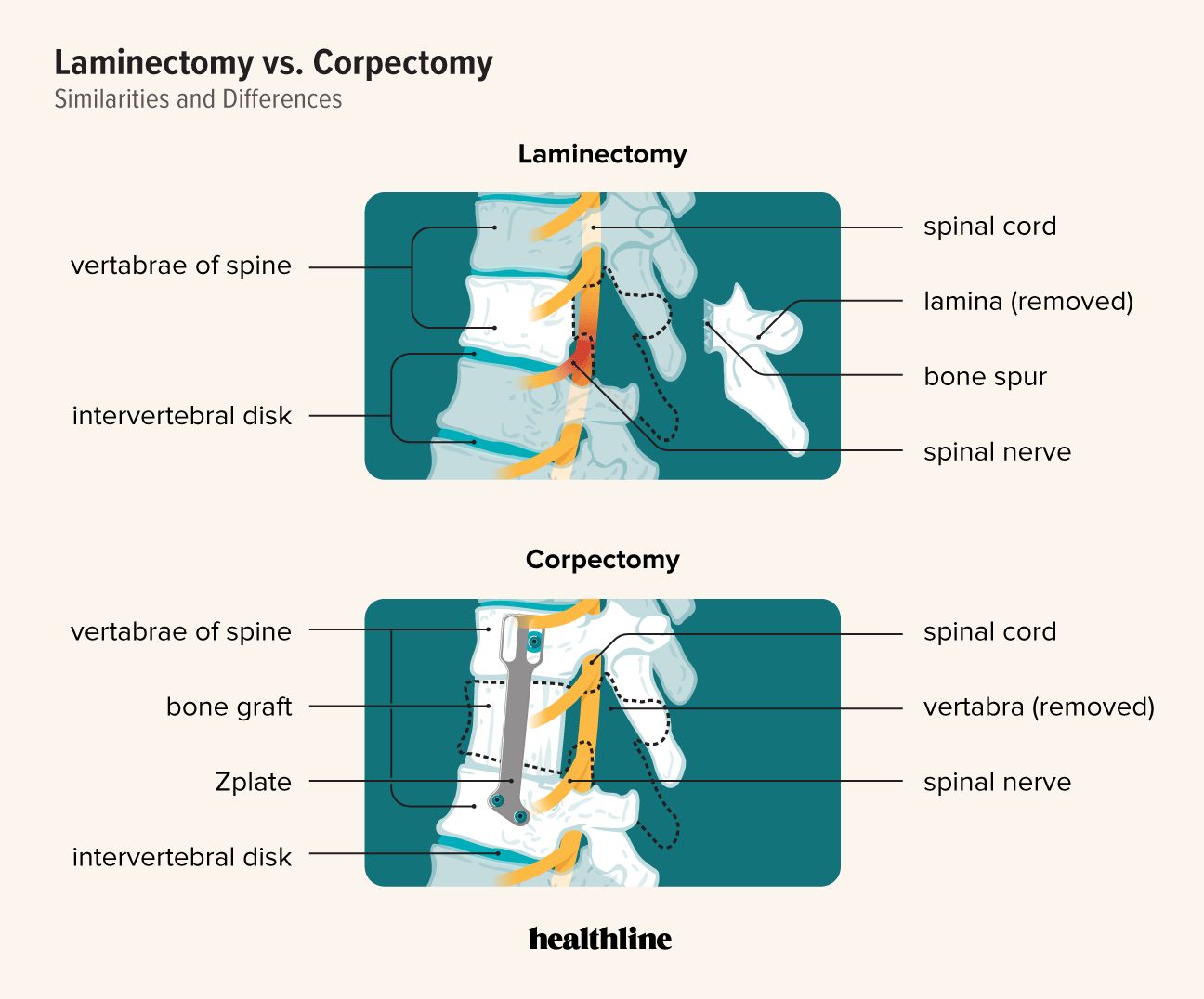 corpectomy vs laminectomy
