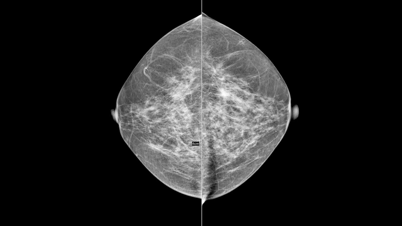 Mammogram image of normal breast