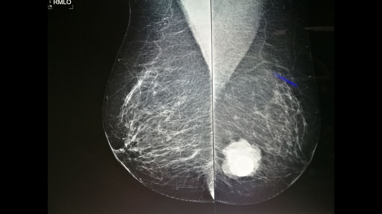 Mammogram image of breast calcifiction
