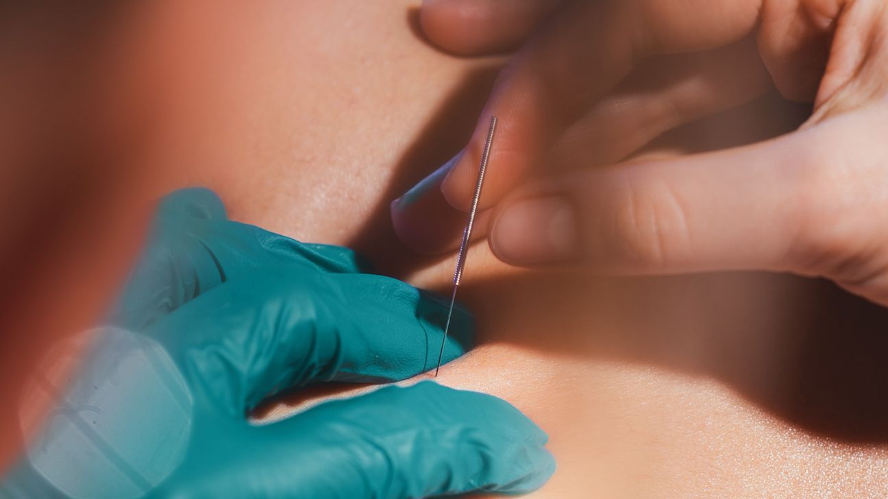 Hand of a healthcare professional performing dry needling on someone's neck for pain relief