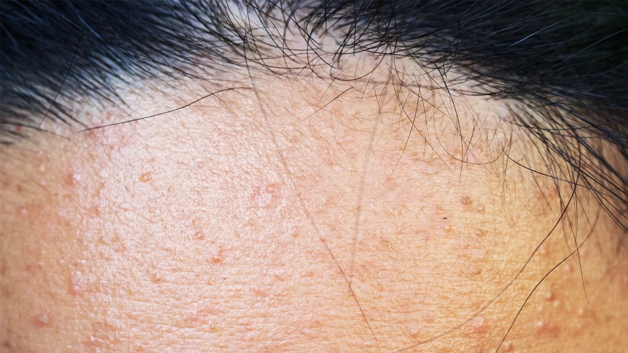 Small redish bumps from ketosis pilaris on someone's forehead. 
