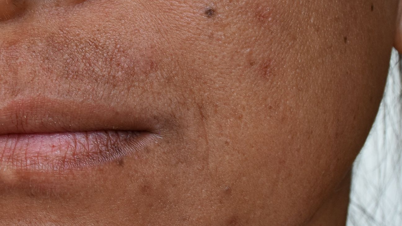 Rosacea on Black Skin: Symptoms, Treatments, and More