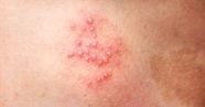 Early Signs Of Herpes Zoster In Cats And Dogs Infoupdate