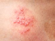 Shingles And Encephalitis Symptoms Causes And Treatment