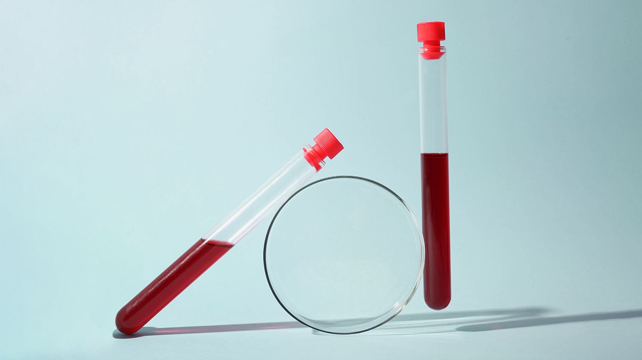 vial with blood for anemia test
