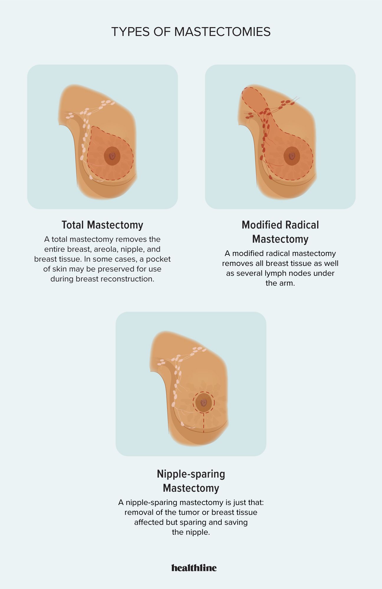 illustrated infographic depicting different types of mastectomy, including total mastectomy, modified radical mastectomy, and nipple-sparing mastectomy