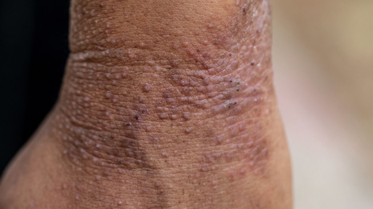 eczema on man's body