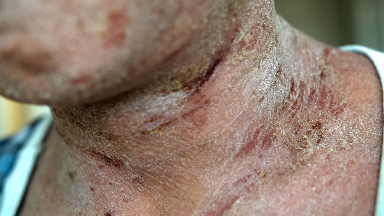 Asian man's neck affected by eczema 