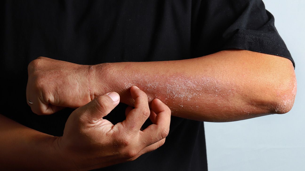 eczema on man's arm