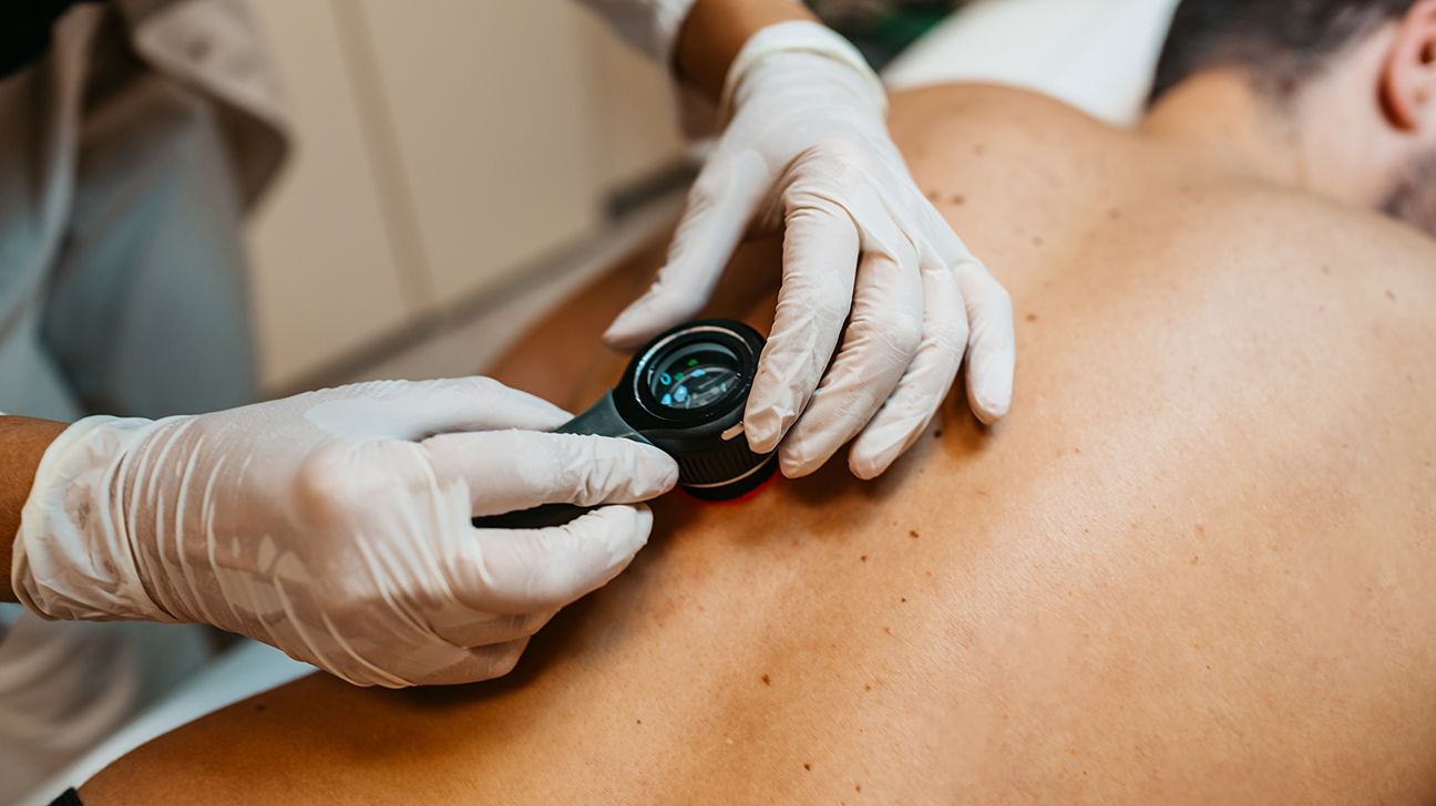 Dermatologist screening person for melanoma skin cancer on their back