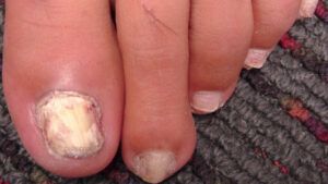 Thickened Nails - Waverley Foot Clinic