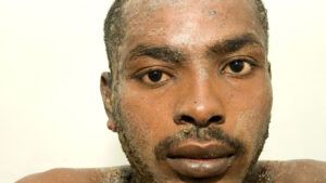 psoriasis on face of male with darker skin tone