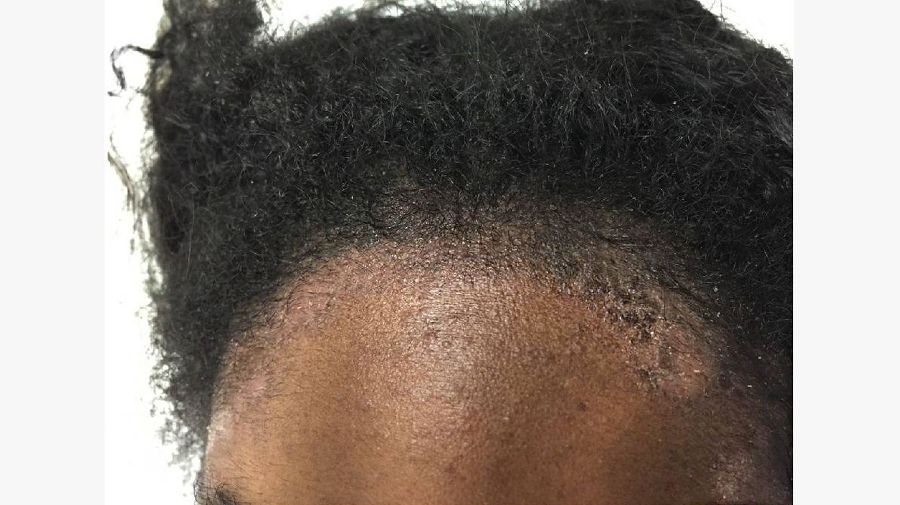 psoriasis scalp treatment natural