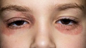 psoriasis plaques around the eyes.