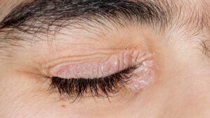 psoriasis vulgaris of the eyelids