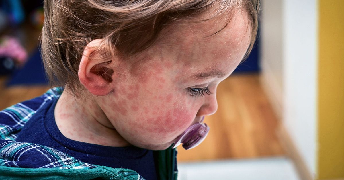 Measles Cases Rise in the United States and Around the World