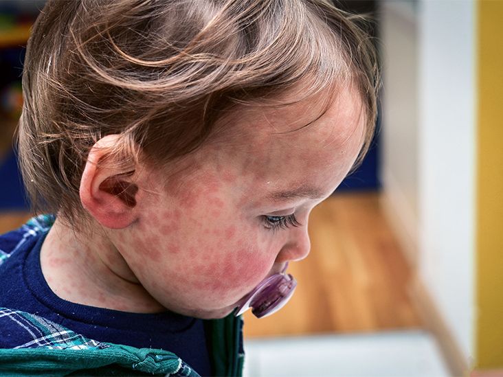 CDC Issues Health Alert Amid Rising Measles Cases, Urges Vaccination