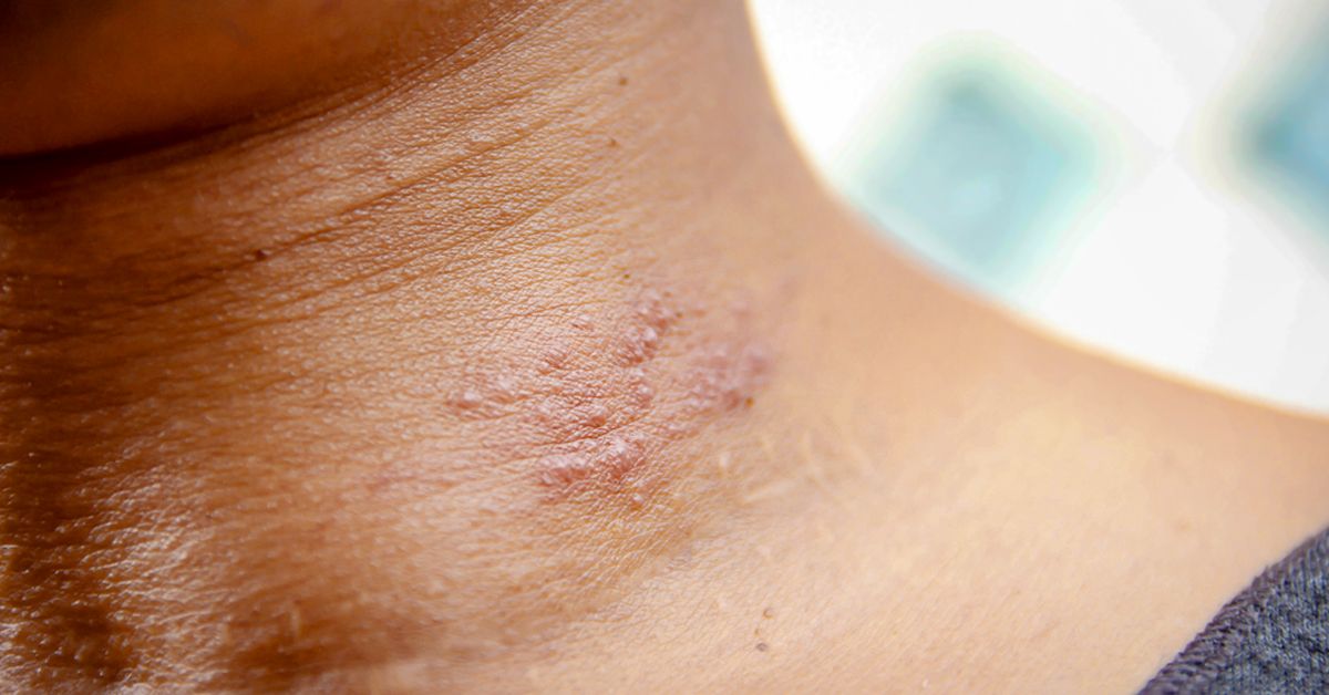 Why Do I Keep Getting Shingles