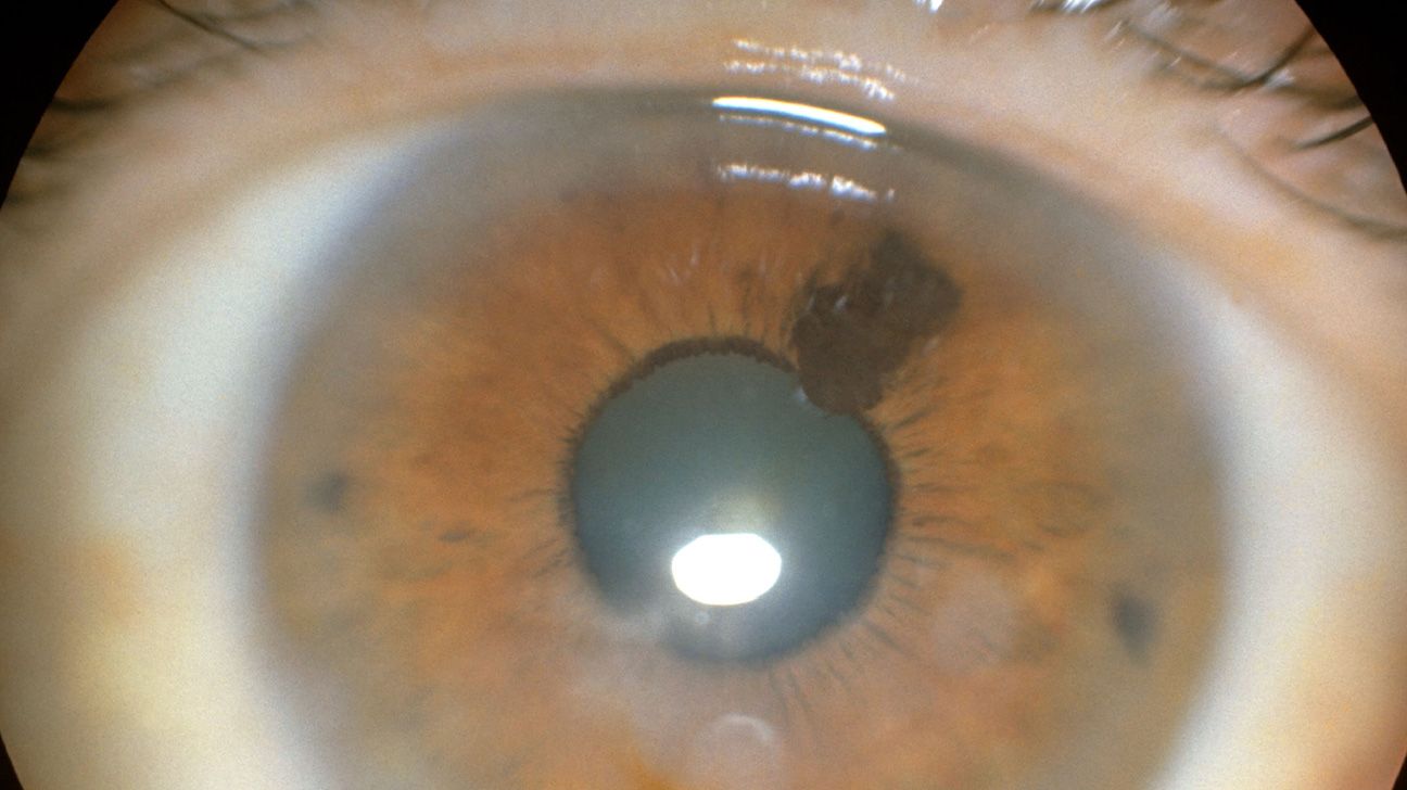 dark spot on the iris of the eye indicating ocular (eye) melanoma