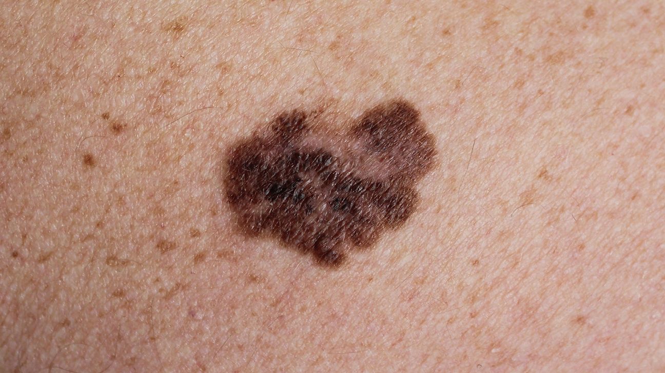 بقعة داكنة على الجلد تشير إلى سرطان الجلد المنتشر سطحيًا