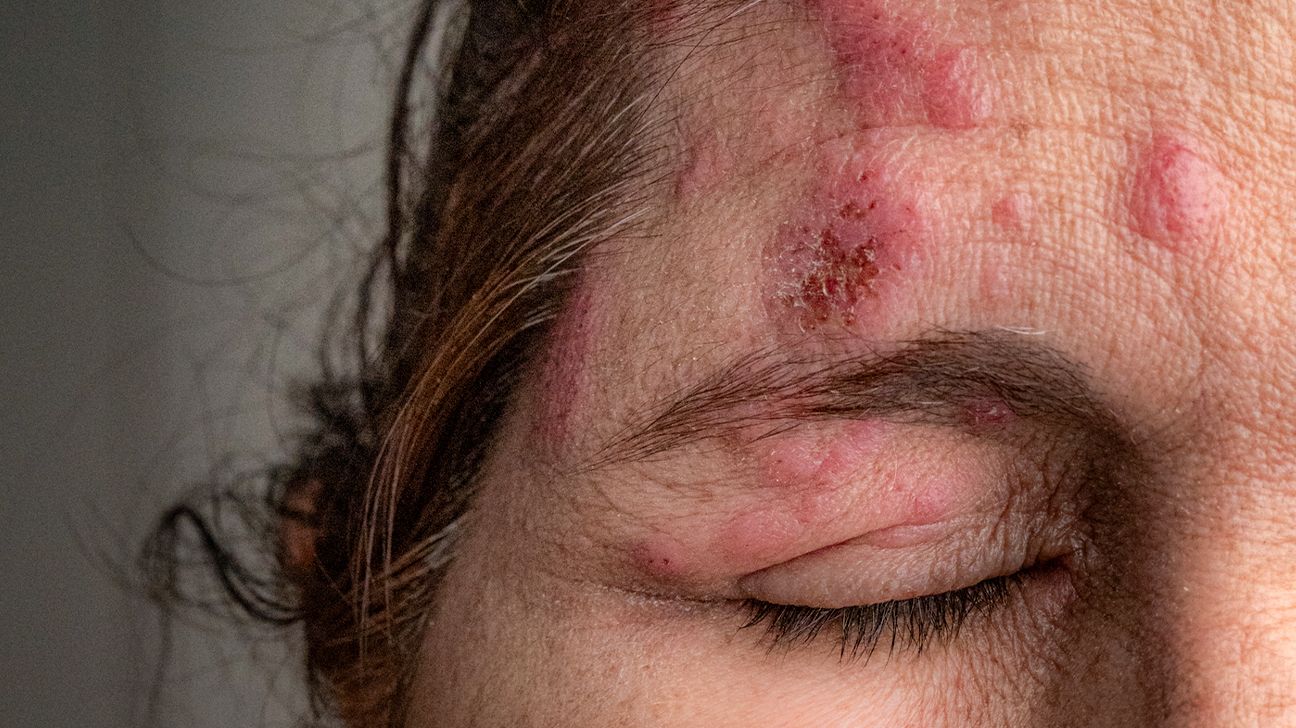 Woman with shingles in the eye spreading from forehead