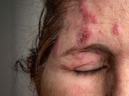 Shingles In The Eye Symptoms Complications And Treatment