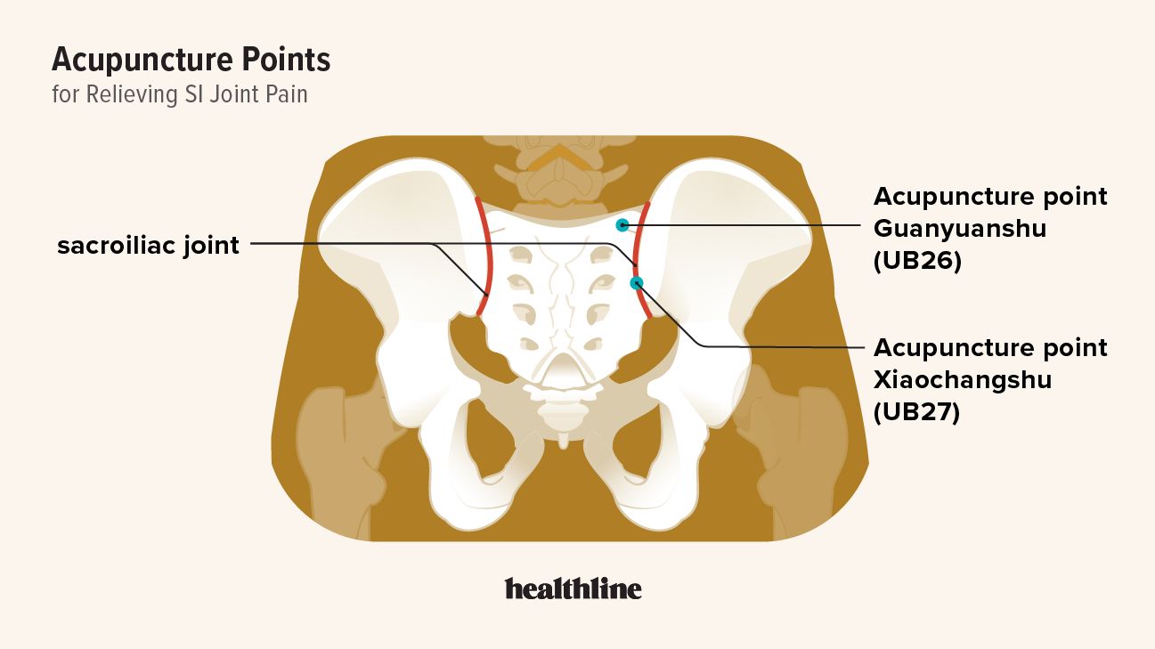 Illustration showing acupuncture points for the SI joint