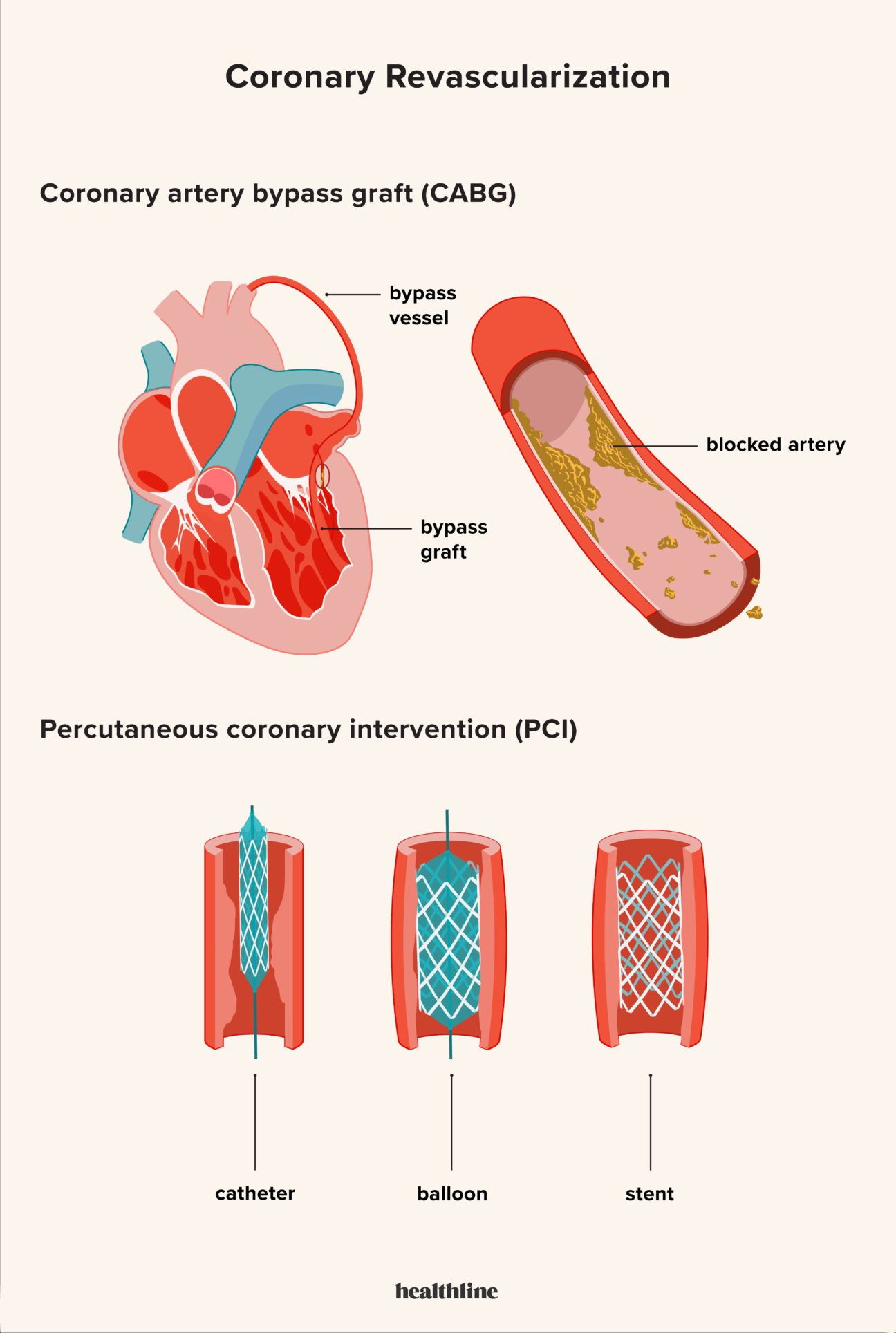 coronary artery bypass graft creating an alternate route for blood flow and percutaneous coronary intervention widening the arterial space