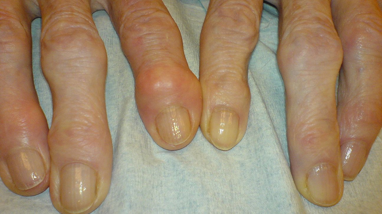 Photo of two hands with Heberden's nodes