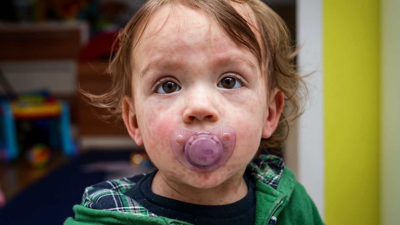 Toddler with measles faces camera.