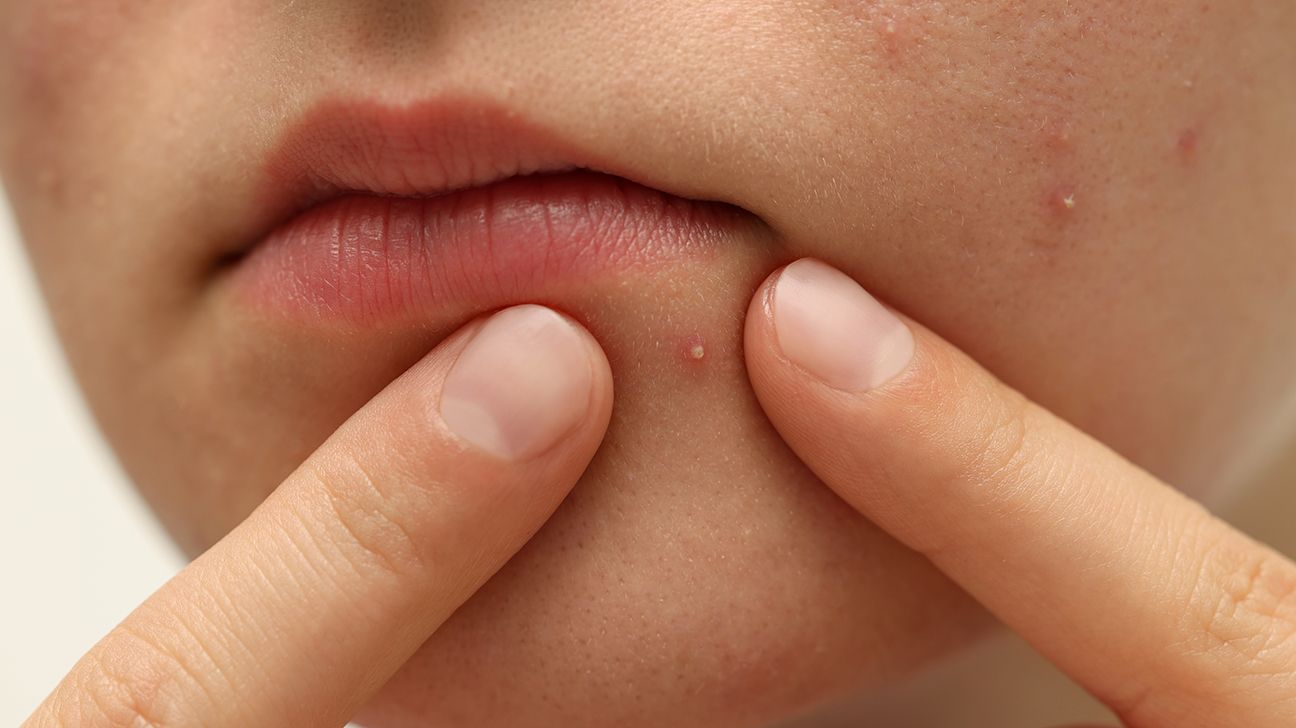 Person placing their fingers around a pimple.