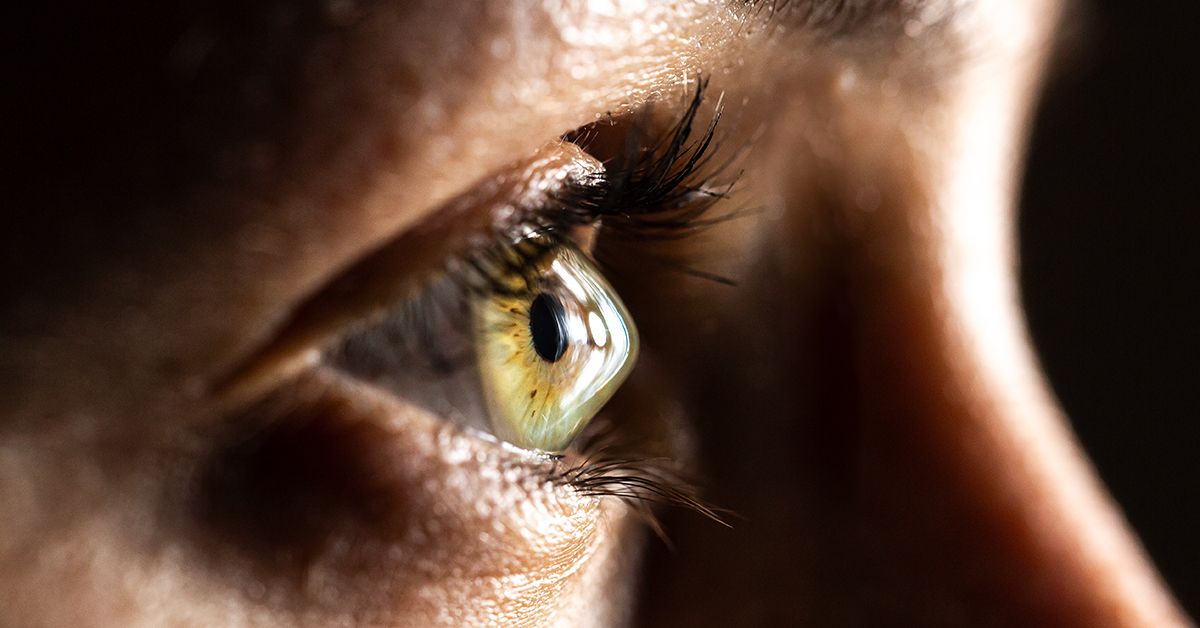 Keratoconus in One Eye: Why Does it Happen?