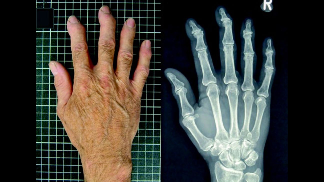 Image of hand alongside X-ray of same hand with erosive arthritis
