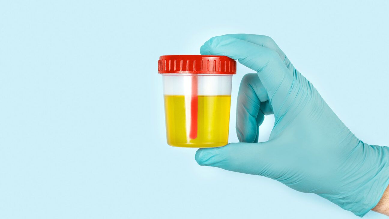 Urine in test cup seen held up by person wearing latex gloves. 