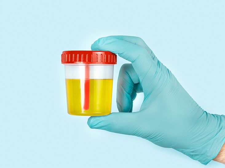 New Urine Test for Prostate Cancer May Help Reduce Unnecessary Biopsies