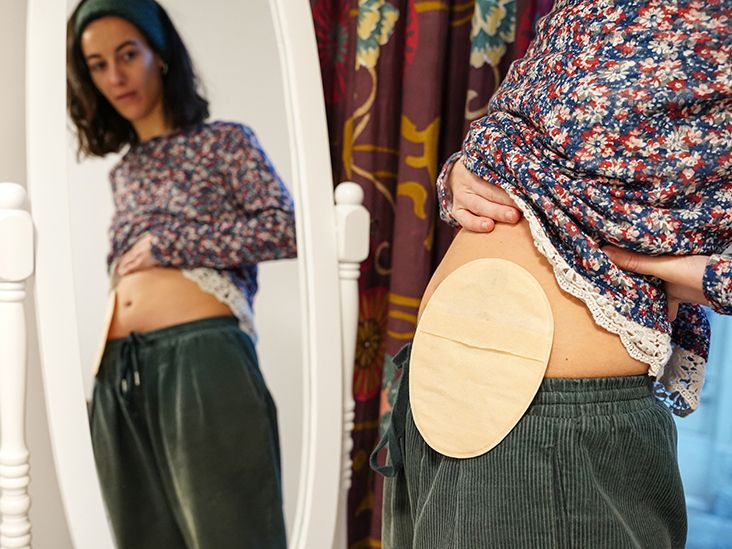 How an Ostomy Pouch Can Affect Your Body Image