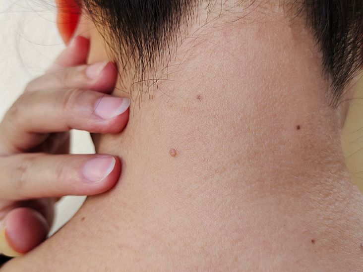 Metastatic Melanoma