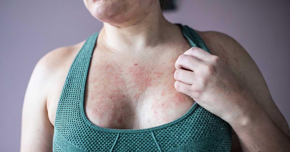 Eczema and Stress: Triggers, Connection, and More