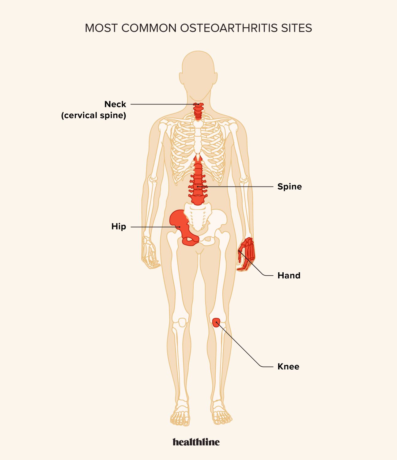 sites most affected by osteoarthritis, specifically the neck, spine, hip, hand, and knee