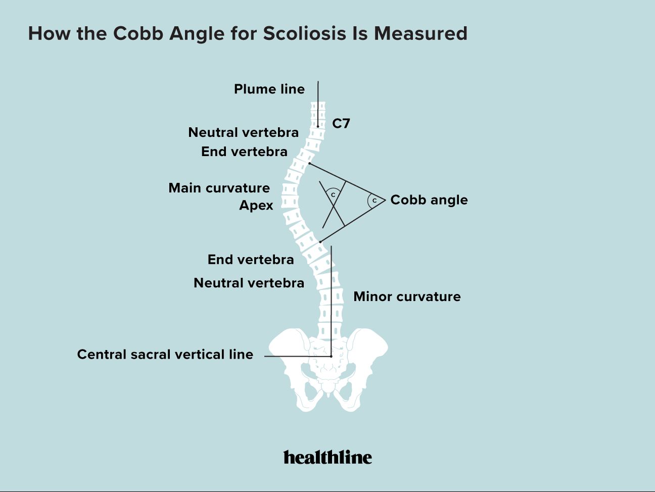 Cobb Angle for Scoliosis: Definition and Uses